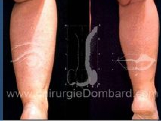 Liposculpture (liposuccion) chevilles mollets - DR Dombard Bruxelles Belgique