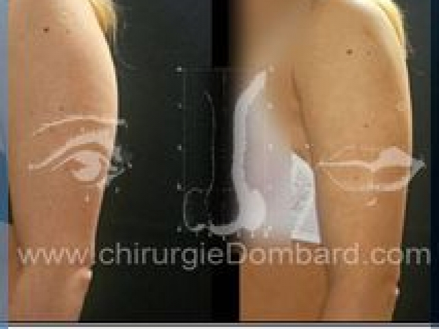 Liposculpture (liposuccion) dermolipectomie des bras - DR Dombard Bruxelles Belgique