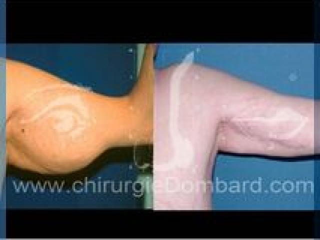 Liposculpture (liposuccion) dermolipectomie des bras - DR Dombard Bruxelles Belgique