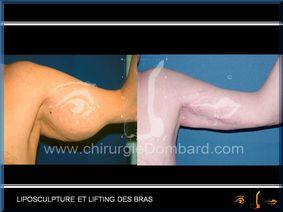 Liposculpture (liposuccion) Dermolipectomie des bras - DR Dombard Bruxelles Belgique