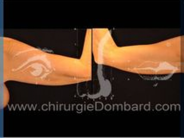 Liposculpture (liposuccion) dermolipectomie des bras - DR Dombard Bruxelles Belgique