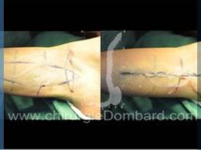 Liposculpture (liposuccion) dermolipectomie des bras - DR Dombard Bruxelles Belgique
