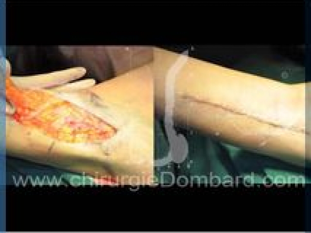 Liposculpture (liposuccion) dermolipectomie des bras - DR Dombard Bruxelles Belgique