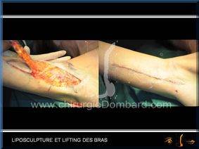 Liposculpture (liposuccion) Dermolipectomie des bras - DR Dombard Bruxelles Belgique