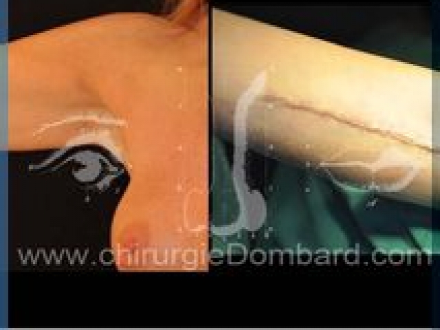 Liposculpture (liposuccion) dermolipectomie des bras - DR Dombard Bruxelles Belgique