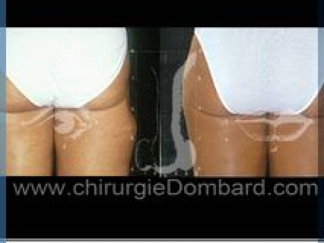 Lipofilling (liposuccion) correction cicatrice - DR Dombard Bruxelles Belgique