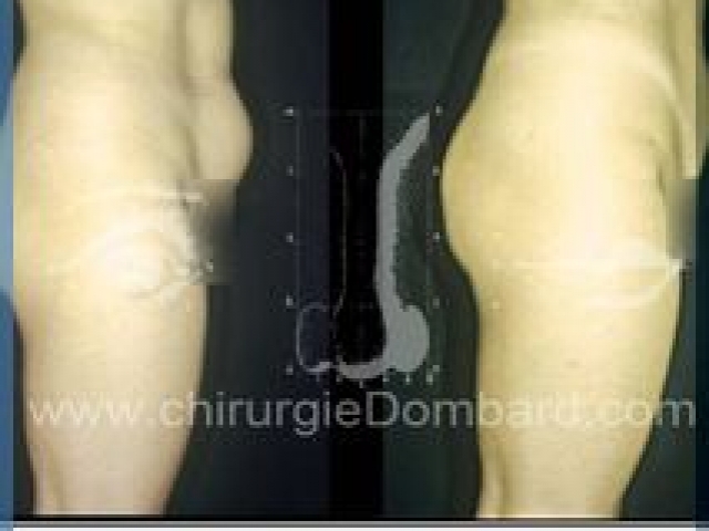 Liposculpture (liposuccion) taille et hanches – Abdomen - DR Dombard Bruxelles Belgique
