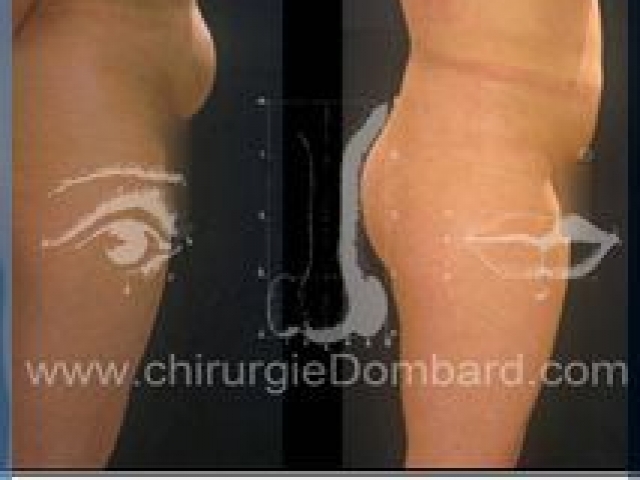 Liposculpture (liposuccion) taille et hanches – Abdomen - DR Dombard Bruxelles Belgique