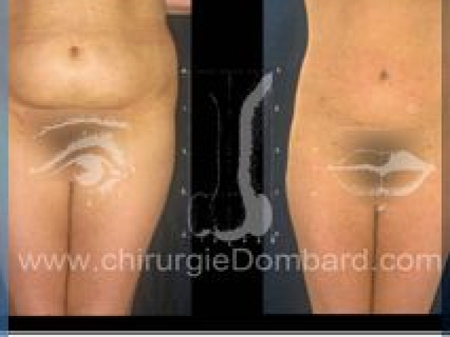 Liposculpture (liposuccion) taille et hanches – Abdomen - DR Dombard Bruxelles Belgique