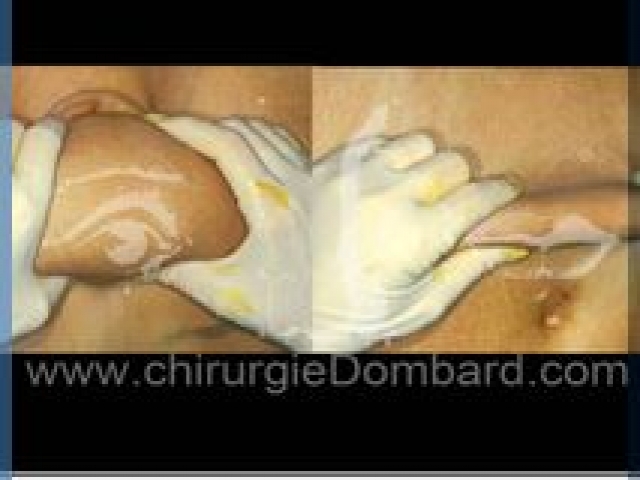 Liposculpture (liposuccion) taille et hanches – Abdomen - DR Dombard Bruxelles Belgique