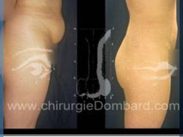 Liposculpture (liposuccion) taille et hanches – Abdomen - DR Dombard Bruxelles Belgique