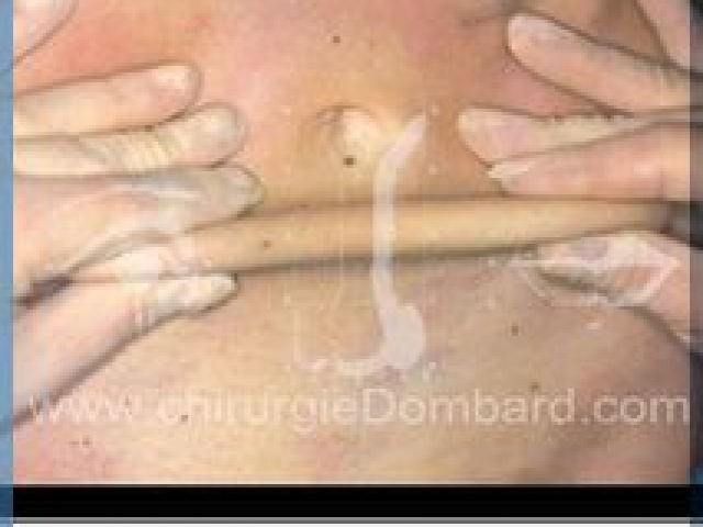 Liposculpture (liposuccion) taille et hanches – Abdomen - DR Dombard Bruxelles Belgique