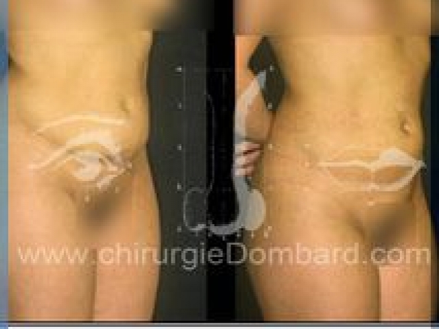 Liposculpture (liposuccion) taille et hanches – Abdomen - DR Dombard Bruxelles Belgique