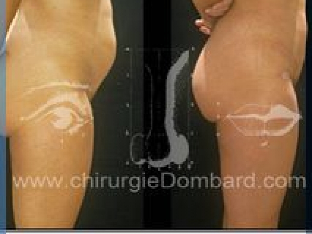 Liposculpture (liposuccion) taille et hanches – Abdomen - DR Dombard Bruxelles Belgique