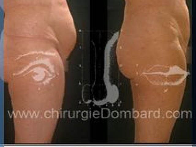 Liposculpture (liposuccion) taille et hanches – Abdomen - DR Dombard Bruxelles Belgique