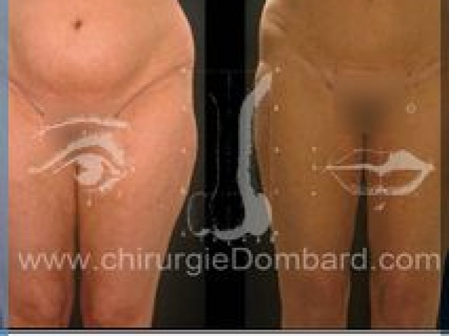 Liposculpture (liposuccion) taille et hanches – Abdomen - DR Dombard Bruxelles Belgique