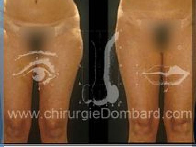 Liposculpture (liposuccion) taille et hanches – Abdomen - DR Dombard Bruxelles Belgique
