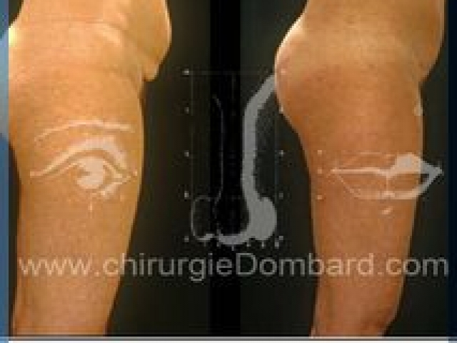 Liposculpture (liposuccion) taille et hanches – Abdomen - DR Dombard Bruxelles Belgique