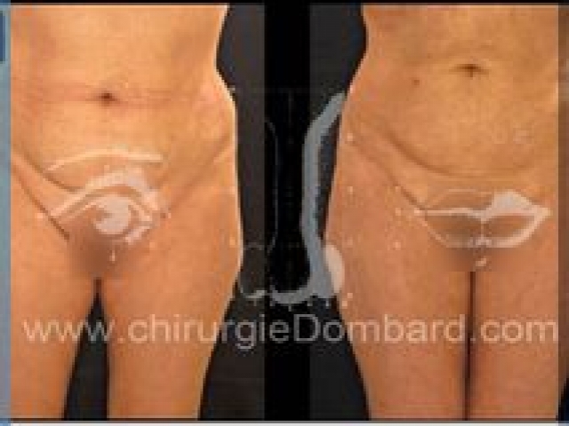 Liposculpture (liposuccion) taille et hanches – Abdomen