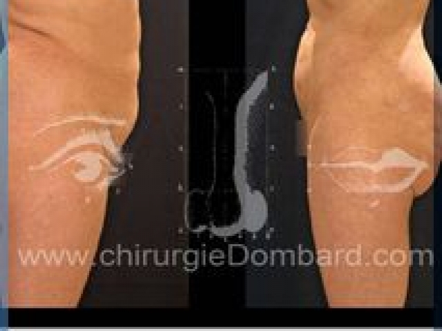 Liposculpture (liposuccion) taille et hanches – Abdomen - DR Dombard Bruxelles Belgique