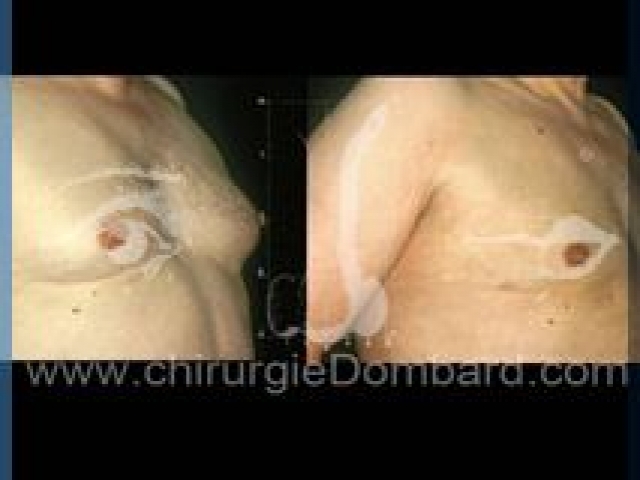 Liposculpture (liposuccion) Gynecomastie - DR Dombard Bruxelles Belgique