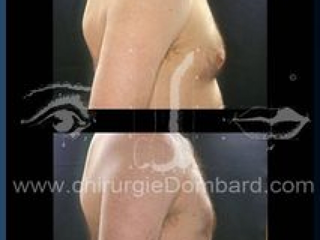Liposculpture (liposuccion) Gynecomastie - DR Dombard Bruxelles Belgique