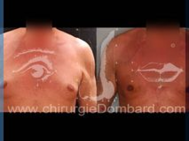 Liposculpture (liposuccion) Gynecomastie - DR Dombard Bruxelles Belgique