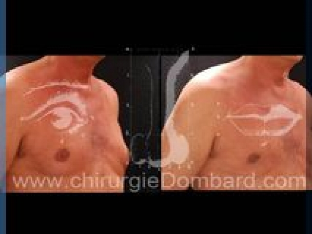 Liposculpture (liposuccion) Gynecomastie - DR Dombard Bruxelles Belgique