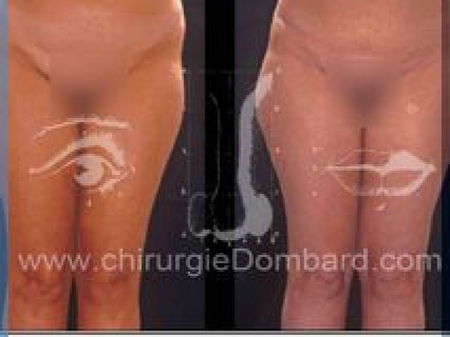 Liposculpture (liposuccion) taille et hanches – Abdomen - DR Dombard Bruxelles Belgique