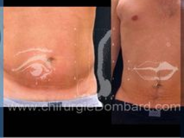 Liposculpture (liposuccion) taille et hanches – Abdomen - DR Dombard Bruxelles Belgique