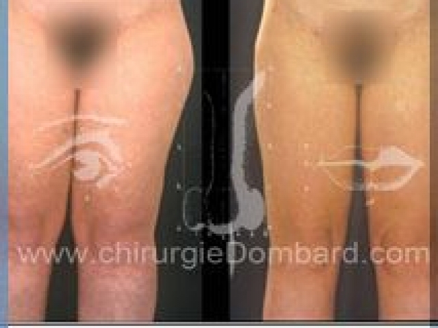 Liposculpture (liposuccion) Culotte Bas des fesses face interne - lipofilling fesses - DR Dombard Bruxelles Belgique