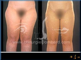 Liposculpture (liposuccion) Culotte Bas des fesses face interne - lipofilling fesses - DR Dombard Bruxelles Belgique