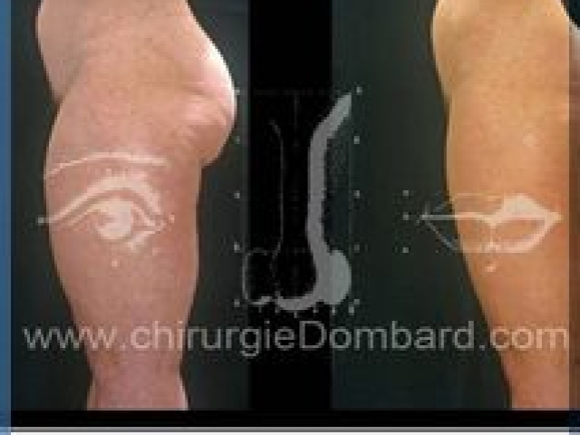Liposculpture (liposuccion) Culotte Bas des fesses face interne - lipofilling fesses - DR Dombard Bruxelles Belgique