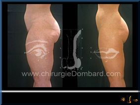 Liposculpture (liposuccion) Culotte Bas des fesses face interne - lipofilling fesses - DR Dombard Bruxelles Belgique