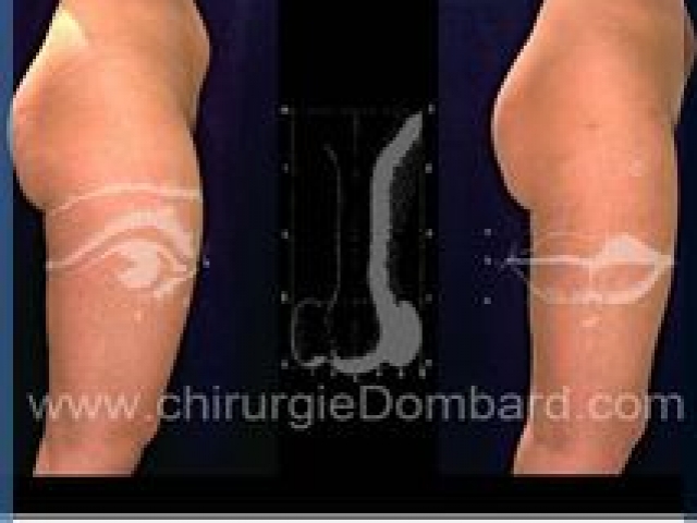 Liposculpture (liposuccion) Culotte Bas des fesses face interne - lipofilling fesses - DR Dombard Bruxelles Belgique