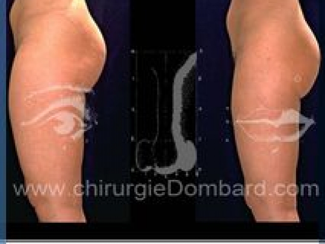 Liposculpture (liposuccion) Culotte Bas des fesses face interne - lipofilling fesses - DR Dombard Bruxelles Belgique
