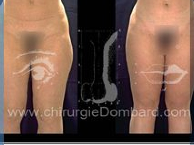 Liposculpture (liposuccion) Culotte Bas des fesses face interne - lipofilling fesses - DR Dombard Bruxelles Belgique