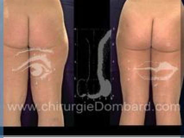Liposculpture (liposuccion) Culotte Bas des fesses face interne - lipofilling fesses - DR Dombard Bruxelles Belgique