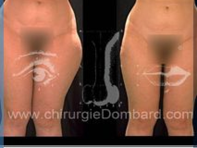 Liposculpture (liposuccion) Culotte Bas des fesses face interne - lipofilling fesses - DR Dombard Bruxelles Belgique
