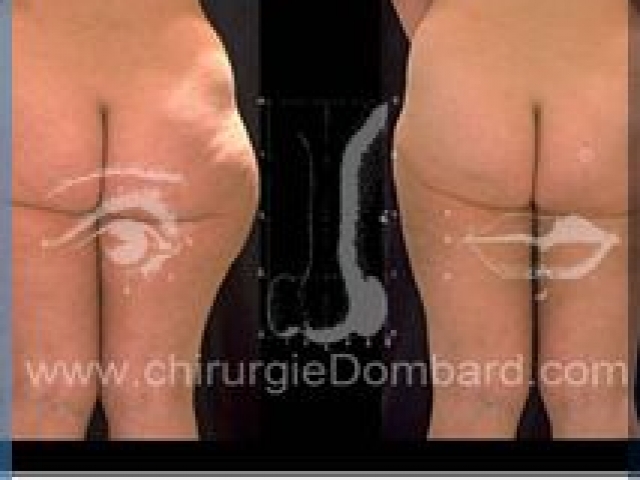 Liposculpture (liposuccion) Culotte Bas des fesses face interne - lipofilling fesses - DR Dombard Bruxelles Belgique