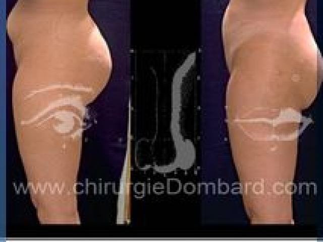 Liposculpture (liposuccion) Culotte Bas des fesses face interne - lipofilling fesses - DR Dombard Bruxelles Belgique