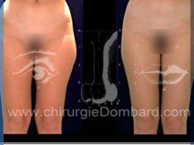 Liposculpture (liposuccion) Culotte Bas des fesses face interne - lipofilling fesses - DR Dombard Bruxelles Belgique