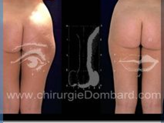 Liposculpture (liposuccion) Culotte Bas des fesses face interne - lipofilling fesses - DR Dombard Bruxelles Belgique