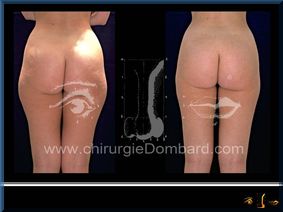 Liposculpture (liposuccion) Culotte Bas des fesses face interne - lipofilling fesses - DR Dombard Bruxelles Belgique