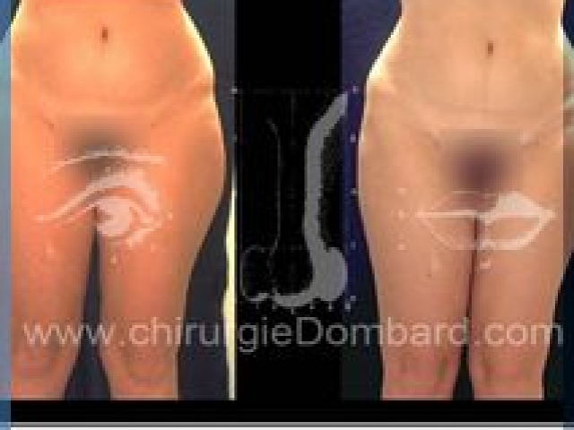 Liposculpture (liposuccion) Culotte Bas des fesses face interne - lipofilling fesses - DR Dombard Bruxelles Belgique