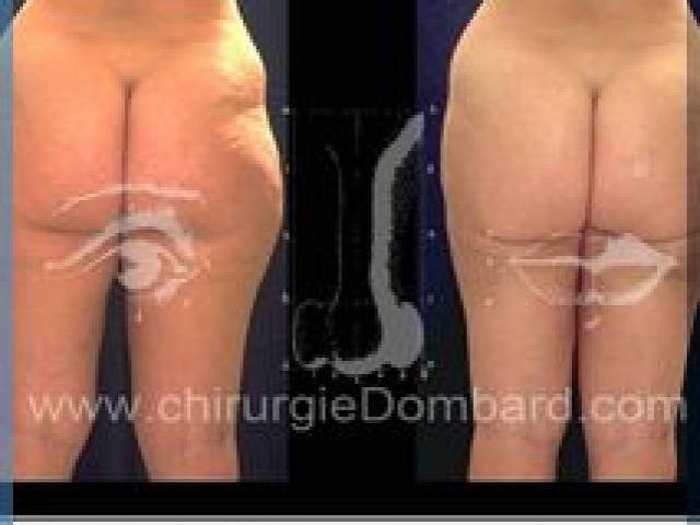 Liposculpture (liposuccion) Culotte Bas des fesses face interne - lipofilling fesses - DR Dombard Bruxelles Belgique