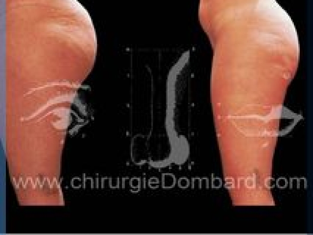 Liposculpture (liposuccion) Culotte Bas des fesses face interne - lipofilling fesses - DR Dombard Bruxelles Belgique