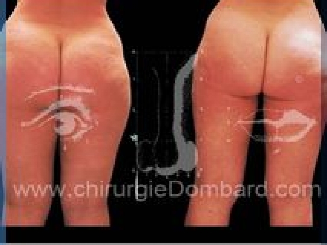 Liposculpture (liposuccion) Culotte Bas des fesses face interne - lipofilling fesses - DR Dombard Bruxelles Belgique