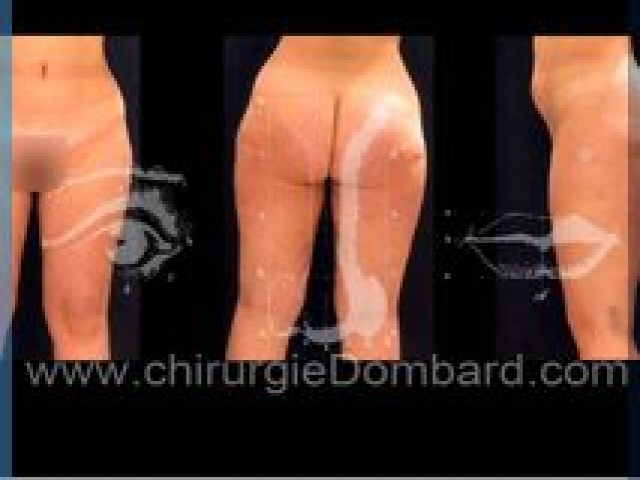 Liposculpture (liposuccion) Culotte Bas des fesses face interne - lipofilling fesses - DR Dombard Bruxelles Belgique