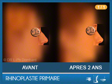 Première chirurgie du nez Primaire - First Rhinoplasty - Neuscorrectie